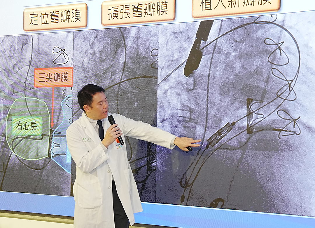 前往 中醫大兒醫完成全台最年輕「經導管三尖瓣瓣中瓣」微創手術 12歲童免再開心手術 健康重返校園生活